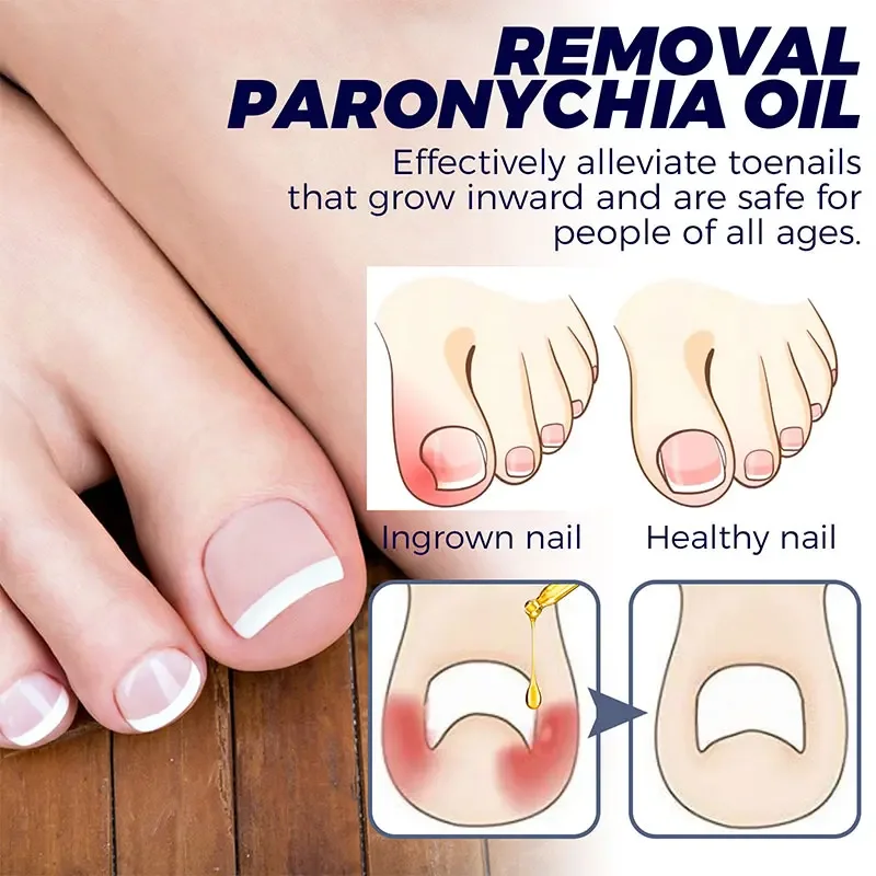 Toenailcare Removal Paronychia Oil Ingrown Toenail Treatment U&ntilde;as Renewal Liquid Bad Nail Thicken Nail Soft Repair Solution manicure pedicure tools nail fungus remover