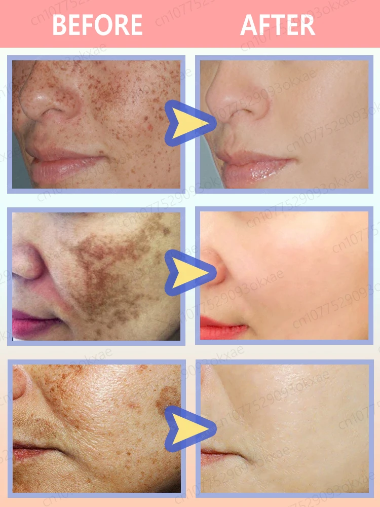 Anti-freckle essence, effectively removes dark spots, age spots, chloasma and freckles in 7 days 6