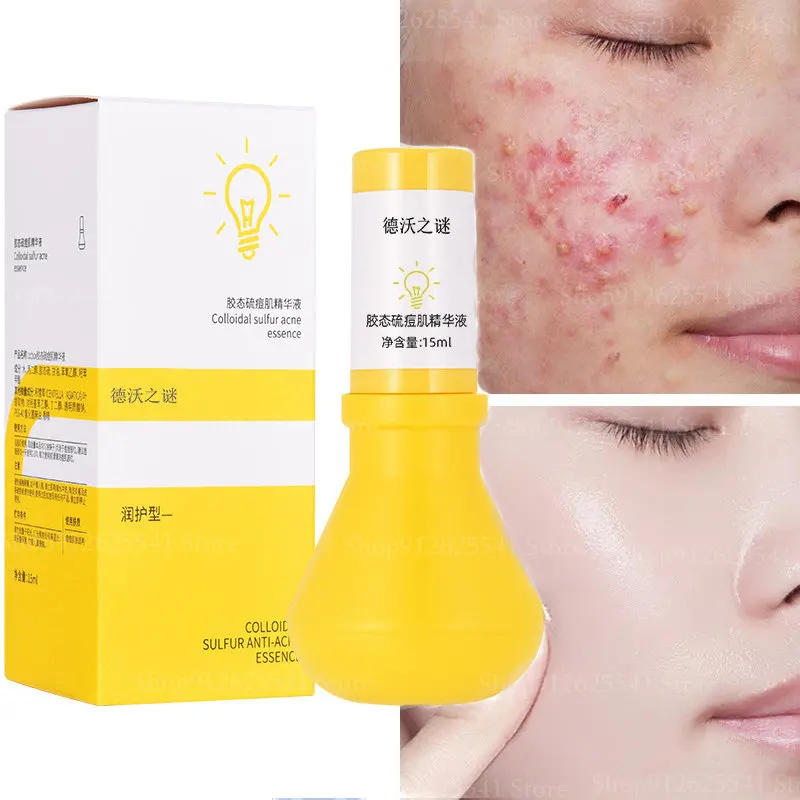 

Acne Treatment Face Serum Remove Blackheads Fade Acne Marks Moisturizing Shrink Pores Acne Facial Serum Korean Skin Care Product