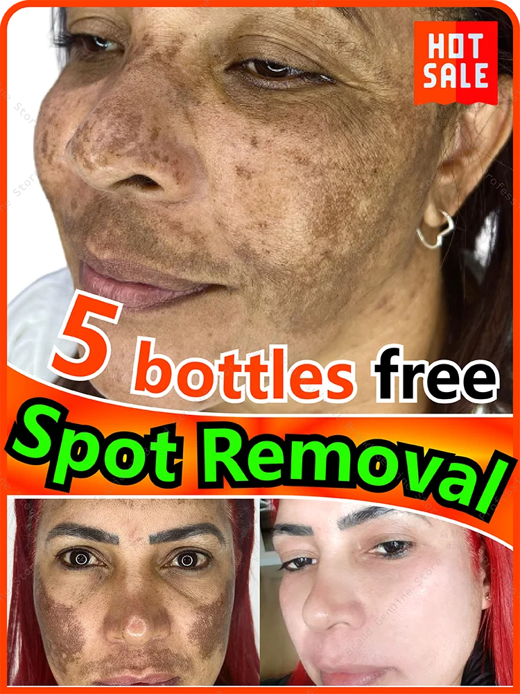 

Spot Removal Chloasma Light Dark