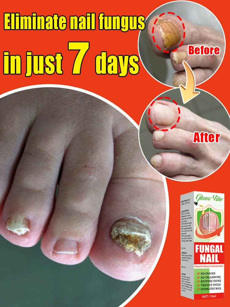 Fungal Nails Onychomycosis
