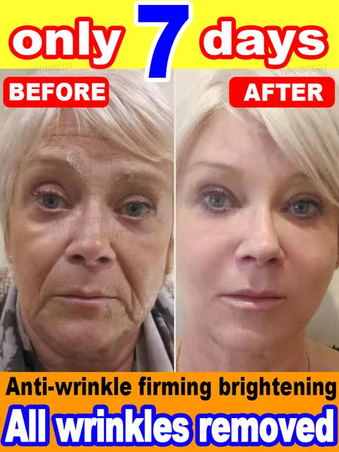 No wrinkles, 20 years younger 2