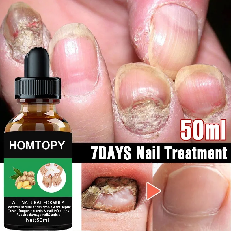 7 Days Nail Fungus Remover Serum Oil Foot Toe Nail Fungus Removal Repair Onychomycosi Anti Infection U&ntilde;as Care Products