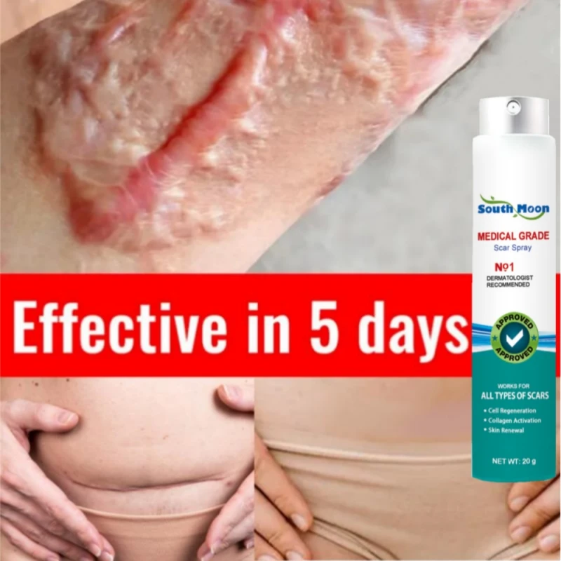 오래된 흉터 제거 스프레이 리페어 스트레치 마크, 켈로이드 화상 수술 흉터 크림, 여드름 치료, 미백 스팟, 부드러운 스킨 케어 