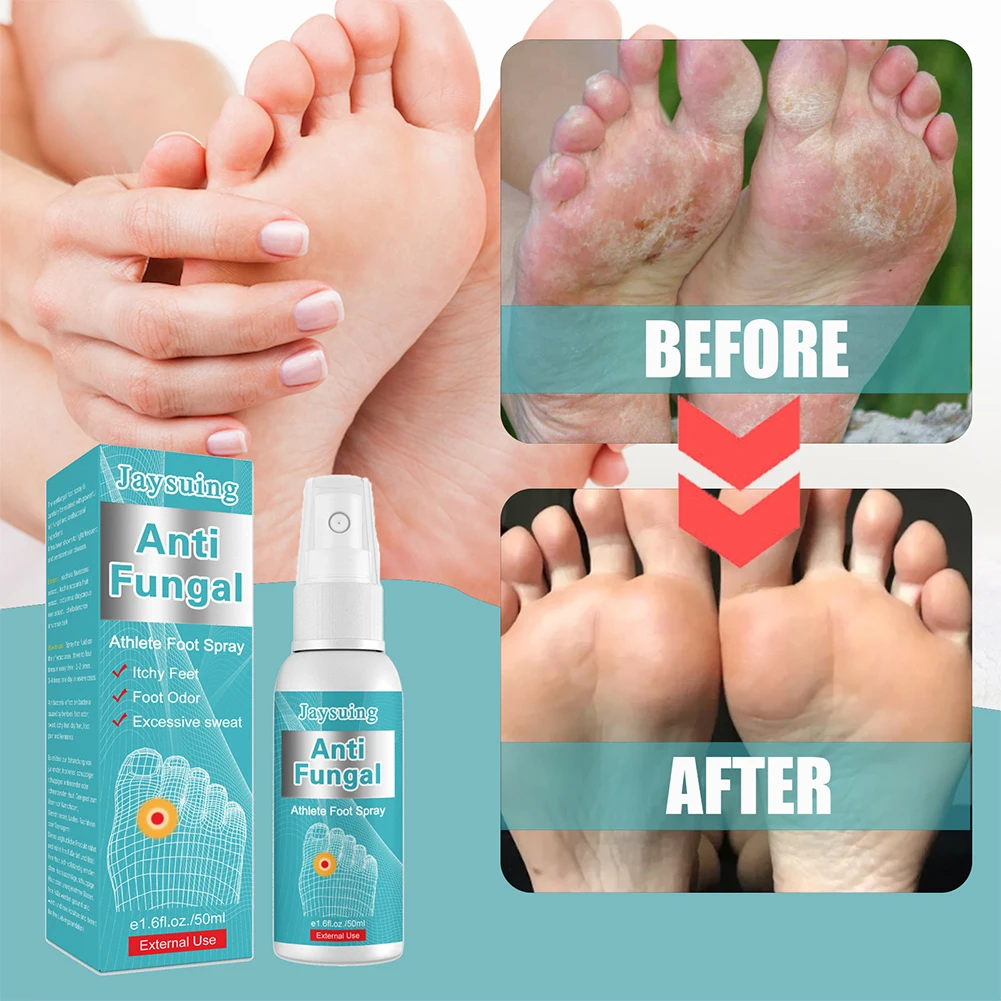 1pcs Anti Fungal Athlete Feet Spray Sterilize Toe Paronychia Foot