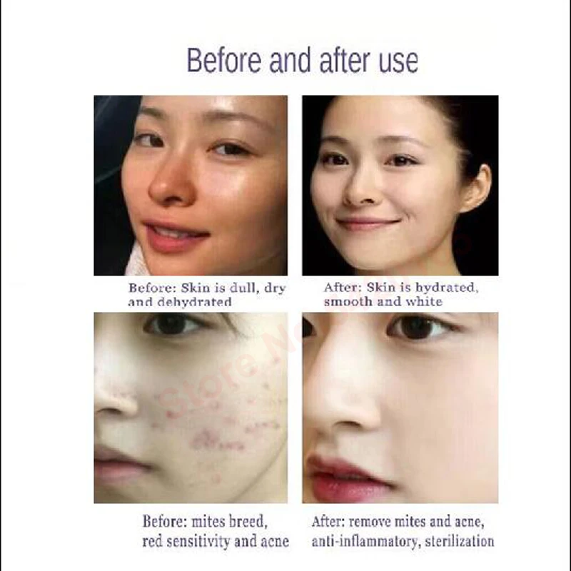 Aqua Peeling Solution Bubble Liquid Hydra Dermabrasion Face Clean Facial Cleansing Blackhead Liquid Beauty Salon 6
