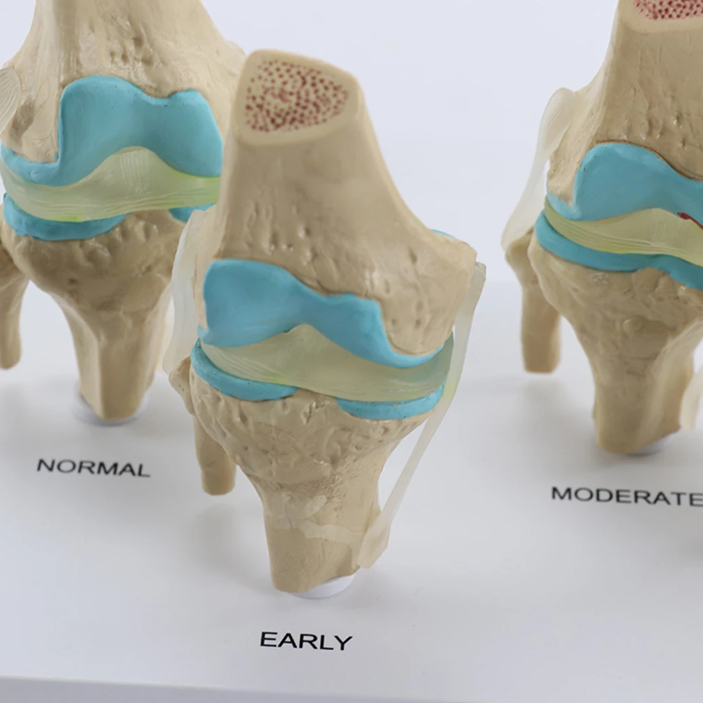 Four-Stage Human Pathological Knee Joint Anatomy Model Medical Science Teaching Resources Kit Models Dropshipping