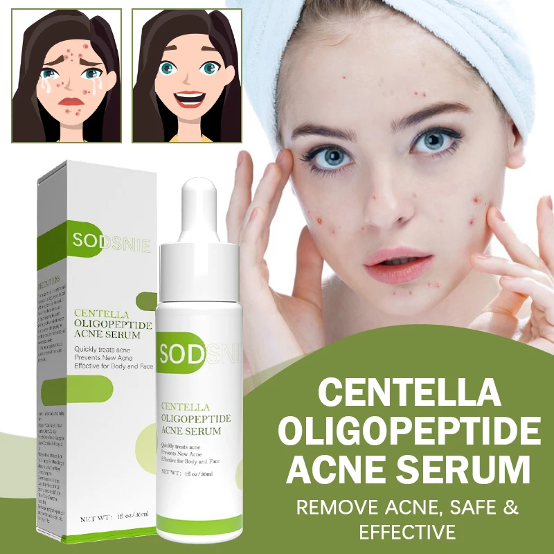 Centella Oligopeptide Acne Serum Moisturizing Anti-Acne Repair Fade Acne Spots Pimple Oil Control Whitening Shrink Pores