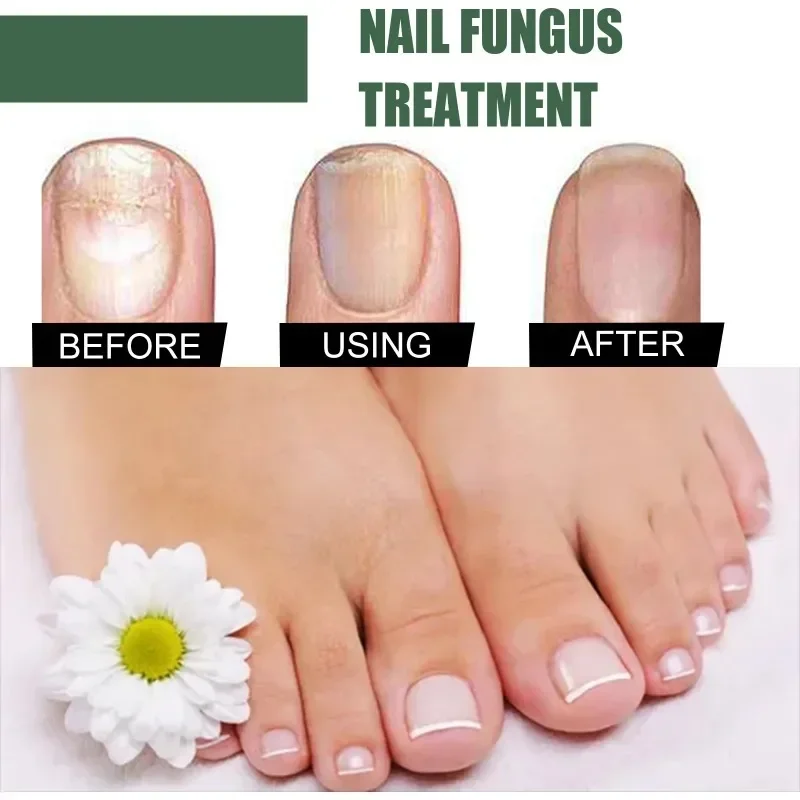 Nail Fungal Treatment Essence Oil Foot Toe Nail Fungus Removal Serum 7 Days Repair Onychomycosi Anti Infection Gel Care Products nail fungus remover