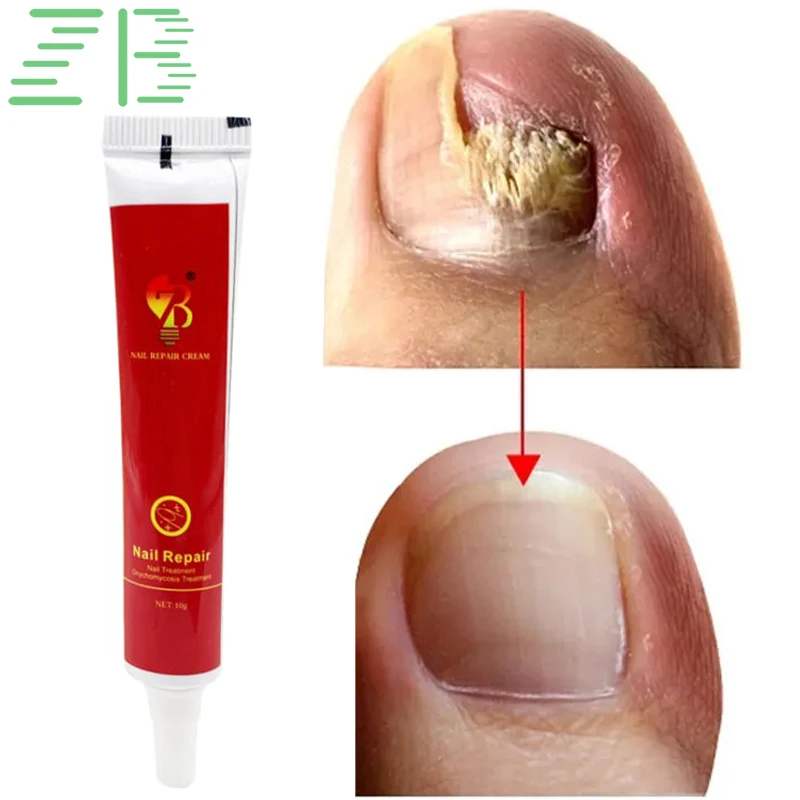 Antibacterial Anti Fungal Cream Nail Fungal Treatment Foot Repair Serum