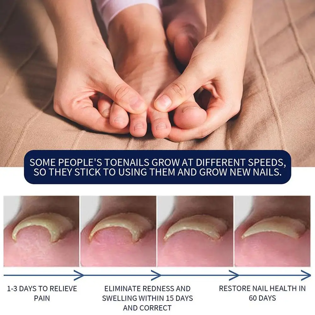 Endogenous Nail Repair Care Essential Oil Essence Clean and Remove Toenail Treatment Feet Care Removal Paronychia Oil