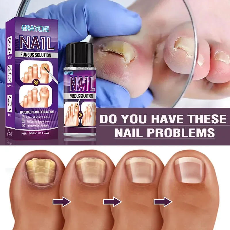 

Nail Repair Essence Nail Growth Polish Fingernail Repair Promotes Repair Function Provides Rich Nutrition Strengthen Nails uñas