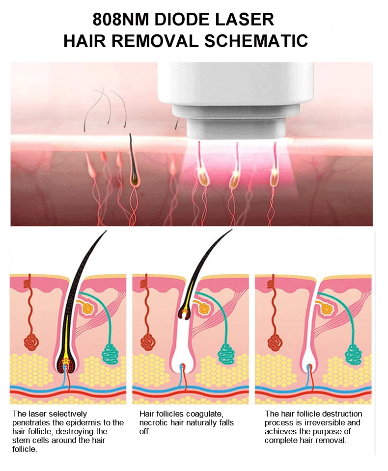 лазерная эпиляция диодным лазером. плюсы диодного лазера для эпиляции. Med 808 диодный лазер. 808 nm adg трехволновый лазерный аппарат hair removal sistem. аппарат диодный лазер для эпиляции m 22.