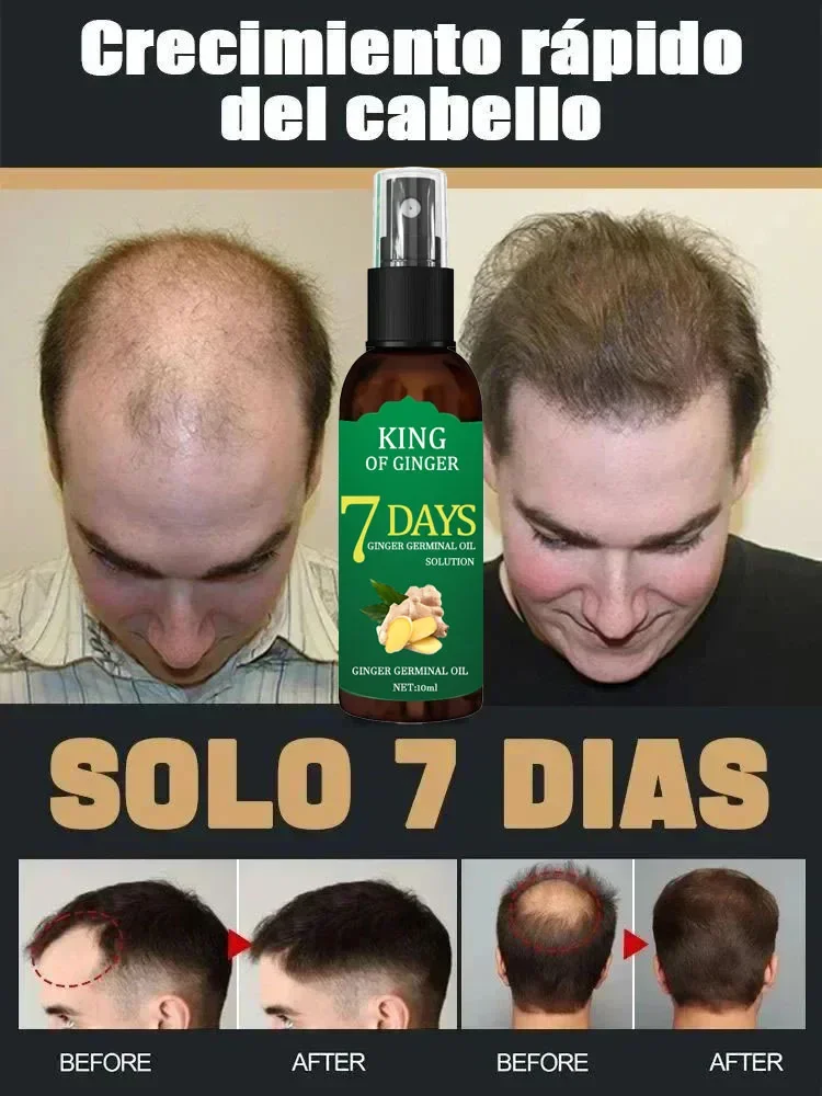 99% of buyers buy again, have more and more hair, say goodbye to baldness, thick hair,Hot selling product