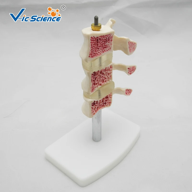 Life Szie Anatomical Human Cutaway Osteoporosis