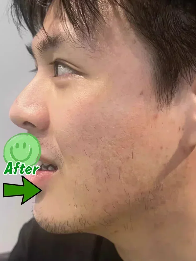 Face Filler Acne-removing Imprints Acne-pits acne-Scars Paste hole filling regeneration shrink pores fade to eliminate acne-pits repair