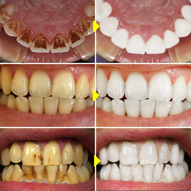 Teeth Cleaner Teeth Whitening Essence Remove Dental Caries Plaque Dirt Serum Fresh Breath Oral Hygiene Dental Tooth Cleaning Tools
