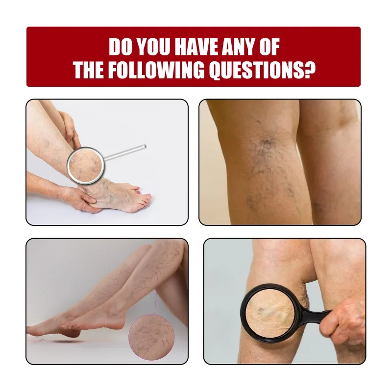 Varicose Veins Gel Phlebitis Worm Spider Legs Vessel Pain Professional Treatment Soothing Reduce Swelling Repair Cream