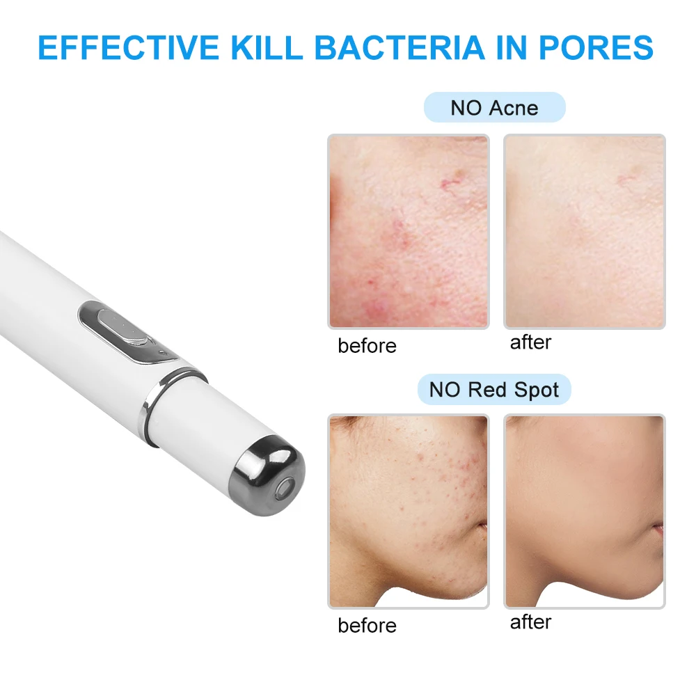 Portable Blue Light Reshaping Laser Pen Varicose Vein Treatment Scar Removal Tool Freckle Acne Treatment Beauty Tool electrotherapy skin care tool blue light therapy pen laser plasma pen remover laser pen therapy