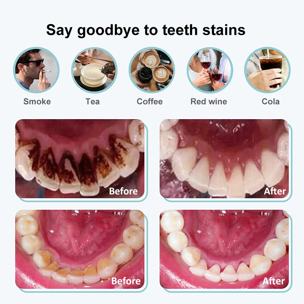 Dental Calculus Remover Ultrasonic Tooth Cleaner Tartar Eliminator Dental Ultrasound Plaque Stains Removal Teeth Whitening Tools 2