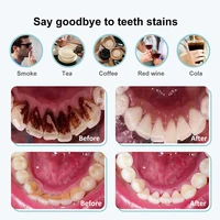 Dental Calculus Remover Ultrasonic Tooth Cleaner Tartar Eliminator Dental Ultrasound Plaque Stains Removal Teeth Whitening Tools 2