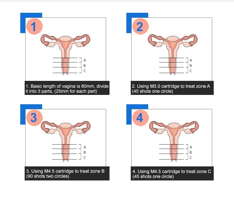 HIFU Vaginale aanscherping