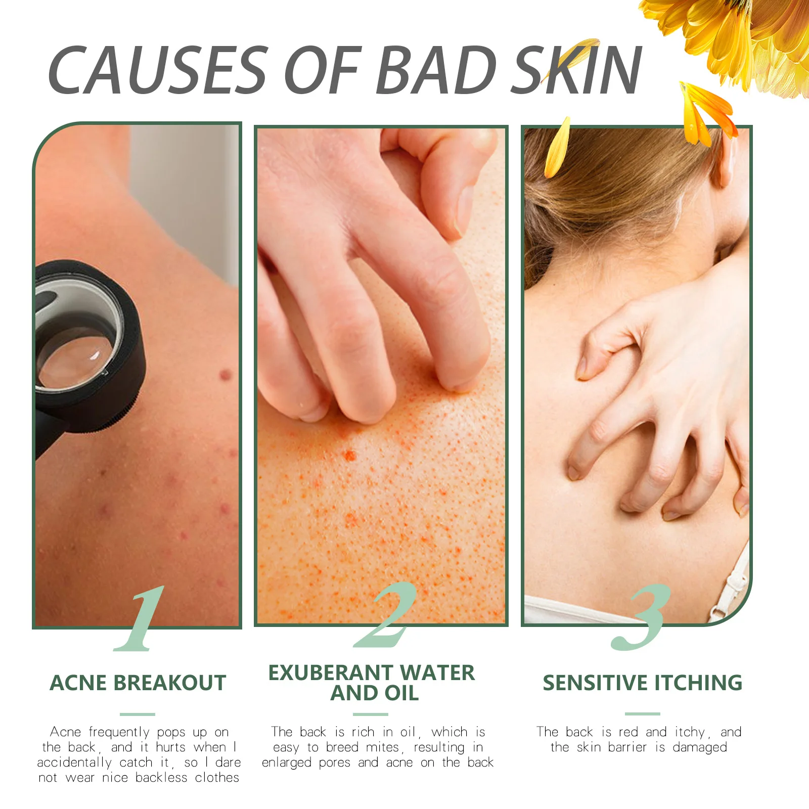 Chicken Skin Repair Cream Curing Body Keratosis Pilaris Remove Acne Spots Rough Bumpy Pores Moisturizing Smooth Whitening Lotion 3