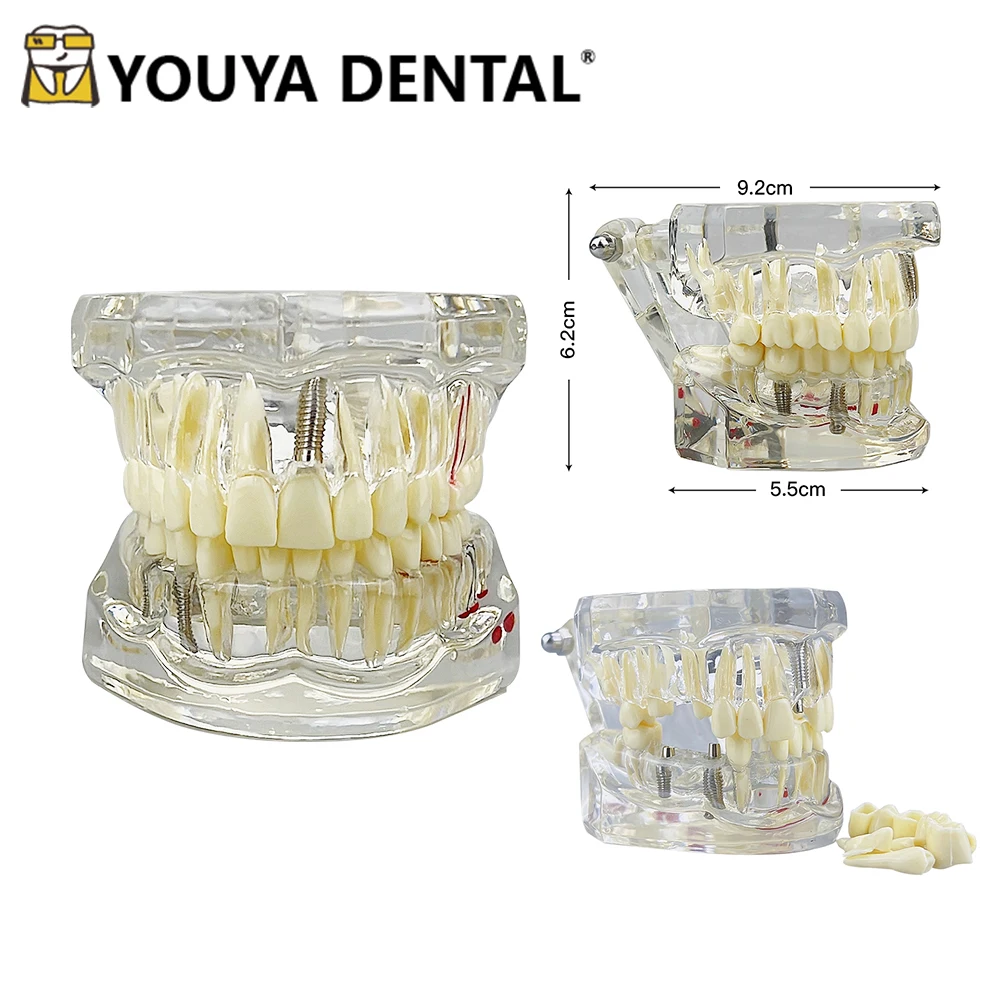 Removable Transparent Disease Teeth Model Teeth Restoration Model for Dentist Student Practice Training Oral Medical Models