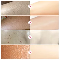 Body Whitening Cream Keratosis Pilaris Treatment Bumpy Rough Chicken Follicle Skin Repair Strawberry Legs Removal Dry Skin Care 2