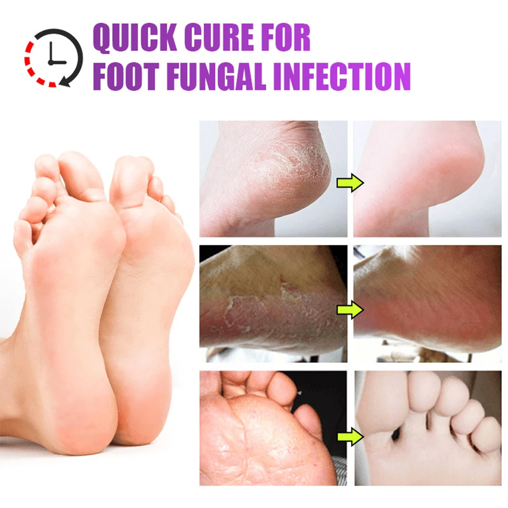Foot Beriberi Treatment Cream Remove Foot Odor Tinea Pedis Cream Anti-Itch Inhibits Fungus Pedicure Prevent Foot Peeling Care