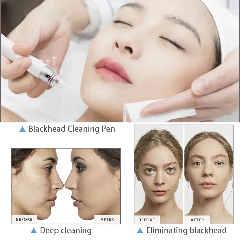 Missheart Professional 6 in 1 H2O2 Small Bubble Device（Overseas Warehouse ping）