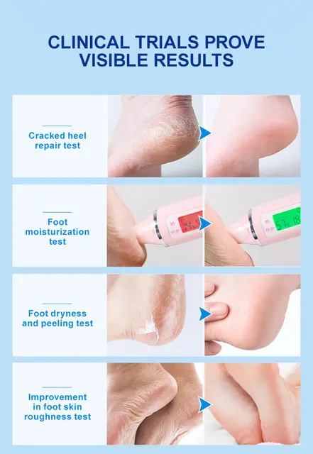 Joypretty Exfoliator Foot Cream Dead Skin Remover Heel Treatment