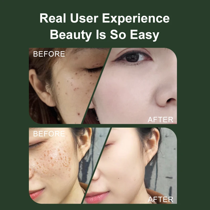 VLVEE 16 Levels LCD Mole Marker Beauty Device Remover Warts Dark Spot Nevus Skin Tag Face Spot Removal Tool Home Use