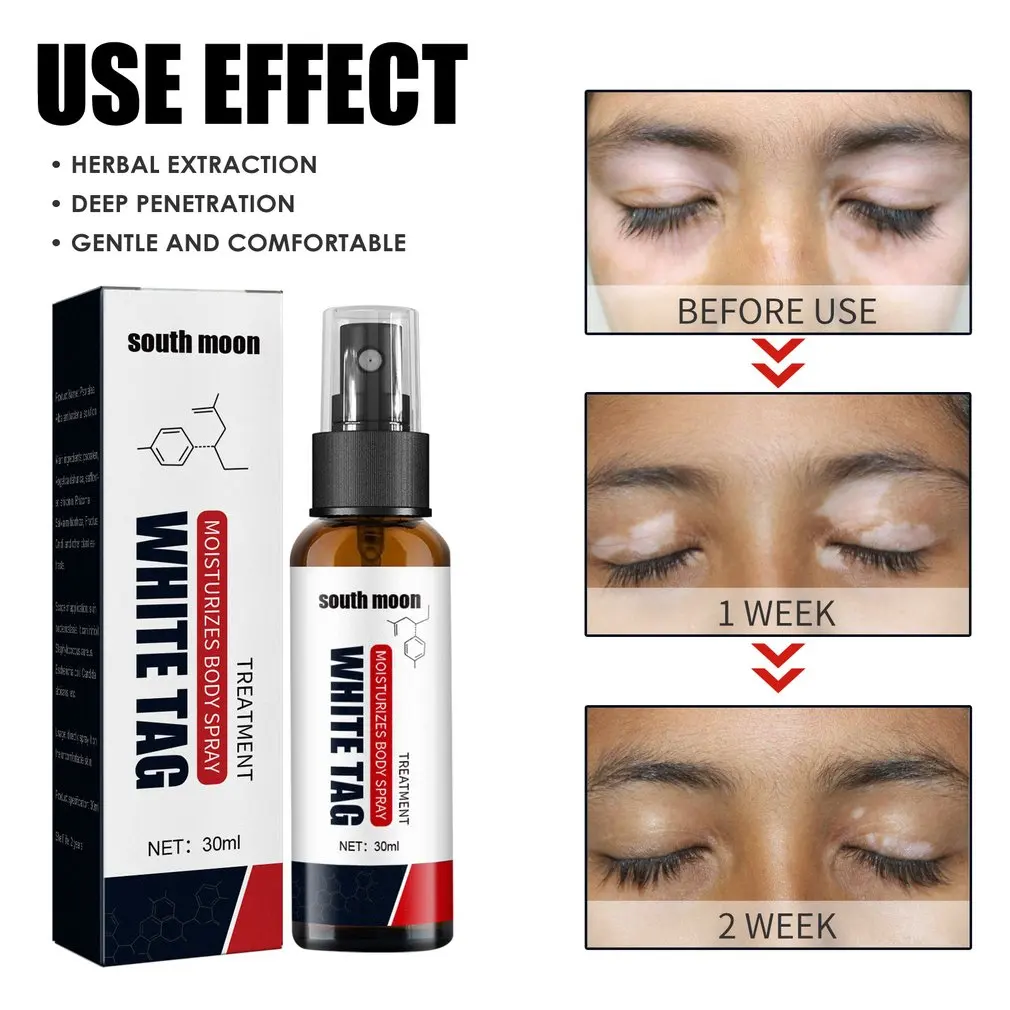 

Anti White Spot Body Spray Anti White Scars Yellow Scars Body Spray Spray For Dark Spots Anti Vitiligo Spray