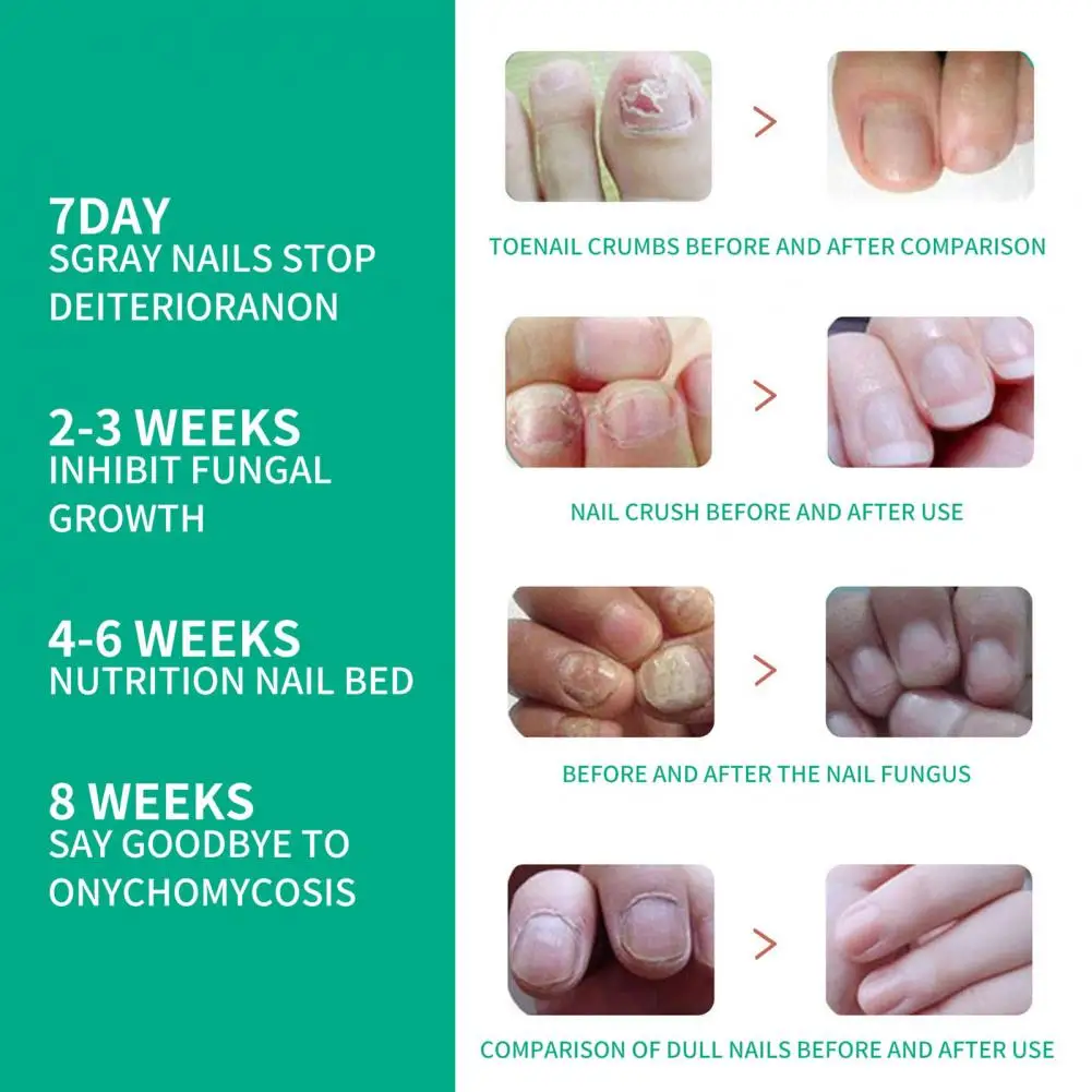 🦶🦠 Fungal Toenails 101: Know... - Michigan Avenue Podiatry | Facebook