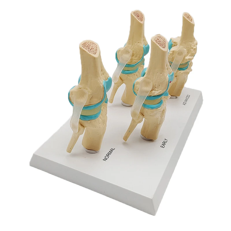 Four-stage Human Pathological Knee Joint Anatomy Model Medical Science Teaching Resources