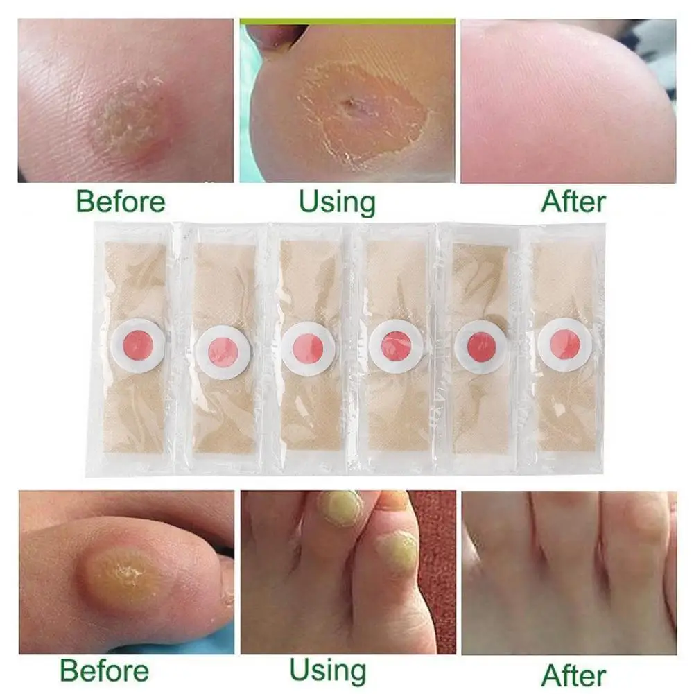 Foot Corn Remover Stickers 6PCS Foot Corn Remover Stickers Painless Medical Plaster Warts Thorn Feet Callus Chicken Eye Treatment Sticker Feet Care