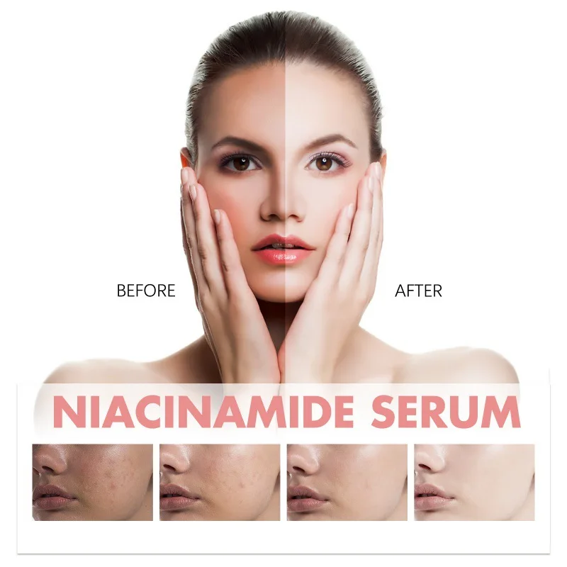 Hoygi Niacinamide Essence Tightens and Moisturizes Pores Lightens Acne Marks and Spots Moisturizes and Brightens Skin Makeup 4