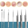 11Pcs Acne Needle Professional Tweezers Acne Remover Ultra-fine No. 5 Cell Pimples Blackhead Clip Facial Pore Cleaning Care Tool 4
