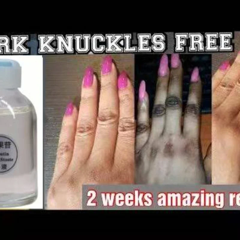 Dark Knuckles Corrector Gel Serum Arbutin Super EFFECTIVE for Dark Spots Dark Knuckles REPAIR  firming skin tightening cream