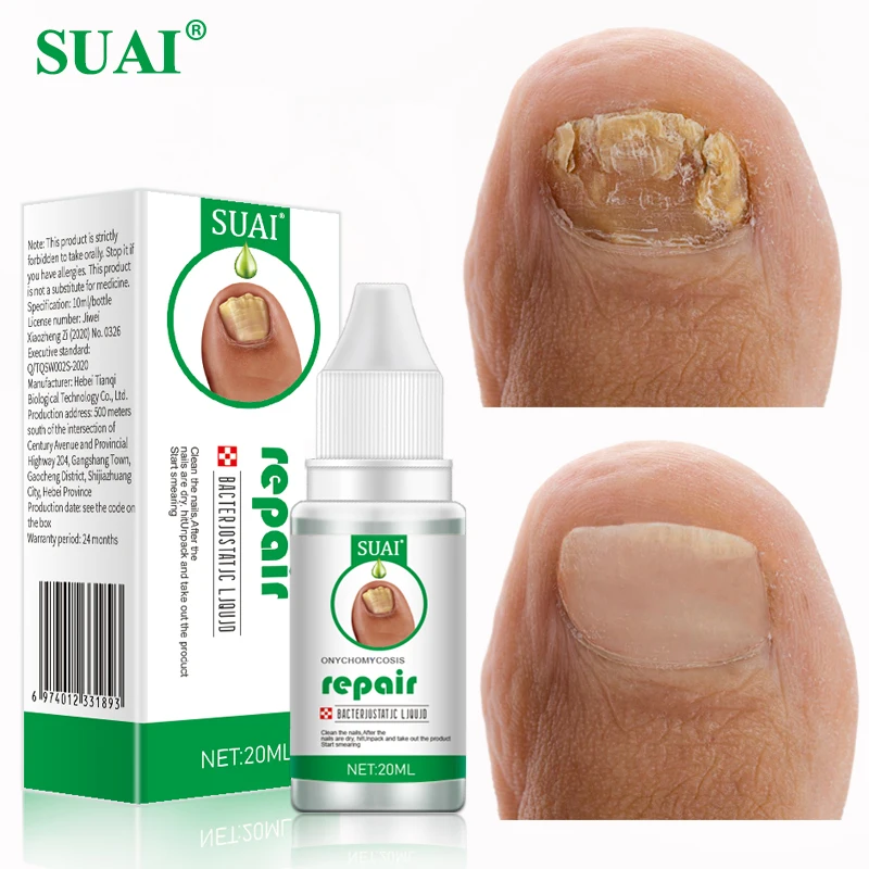 SUAI Nail Fungus Treatment Onychomycosis Serum Paronychia Anti