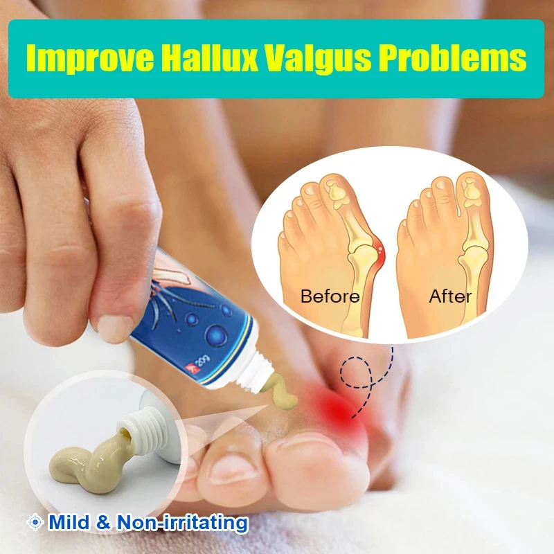 ZB 20g Foot Gout Treatment Cream Thumb Corrector Finger Hallux Ointment Toe Bunion Pain Relieve Medical Plaster Health Care