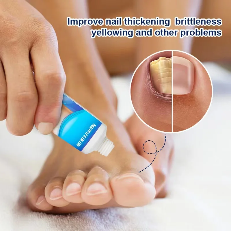 Corded Nail Fungal Lamp Treatment Device Repair Toenail Fingernail Fungus Treat Onychomycosis Laser Nails With Toe Care Cream