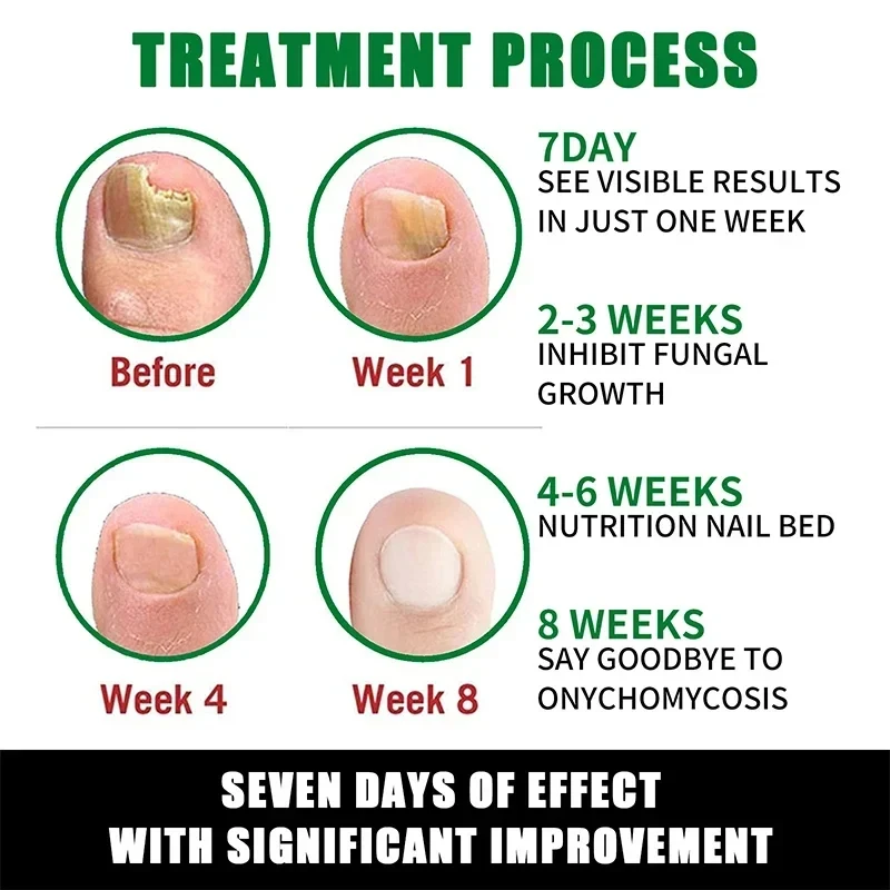 7 Day Nail Fungal Treatment Serum Foot Toe Nail Fungus Removal Essential Oil Anti Infection Onychomycosis Paronychia Repair Gel nail fungus remover