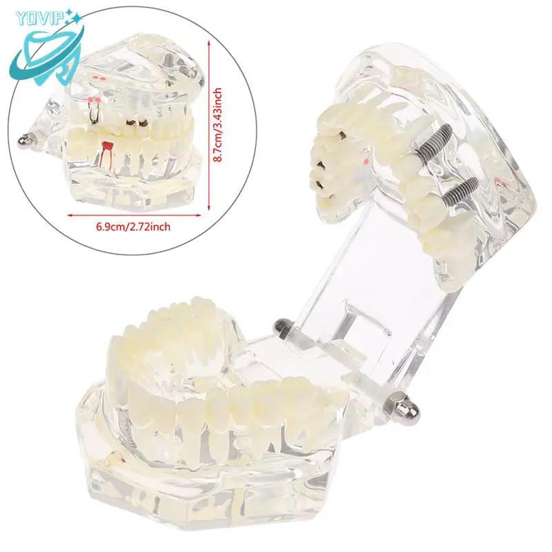 

1pc Disease Teeth Model With Restoration Bridge Tooth Dentist For Medical Science Dental Disease Teaching Study Dental Implant