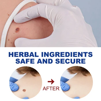 Wart Removal Mole Remedy Liquid Pen Treatment Papillomas Removing Skin Labels Flat Wart Genitals Painless Beauty Herbal Cream 5