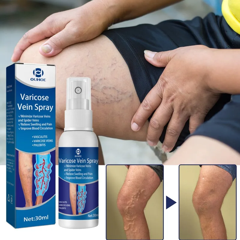 Body Cream 30ml Varicose Vein Spray Vasculitis Phlebitis Relief Cream Spider Legs Treatment Smoothing Blood Vessel Redness Herbal Body Care