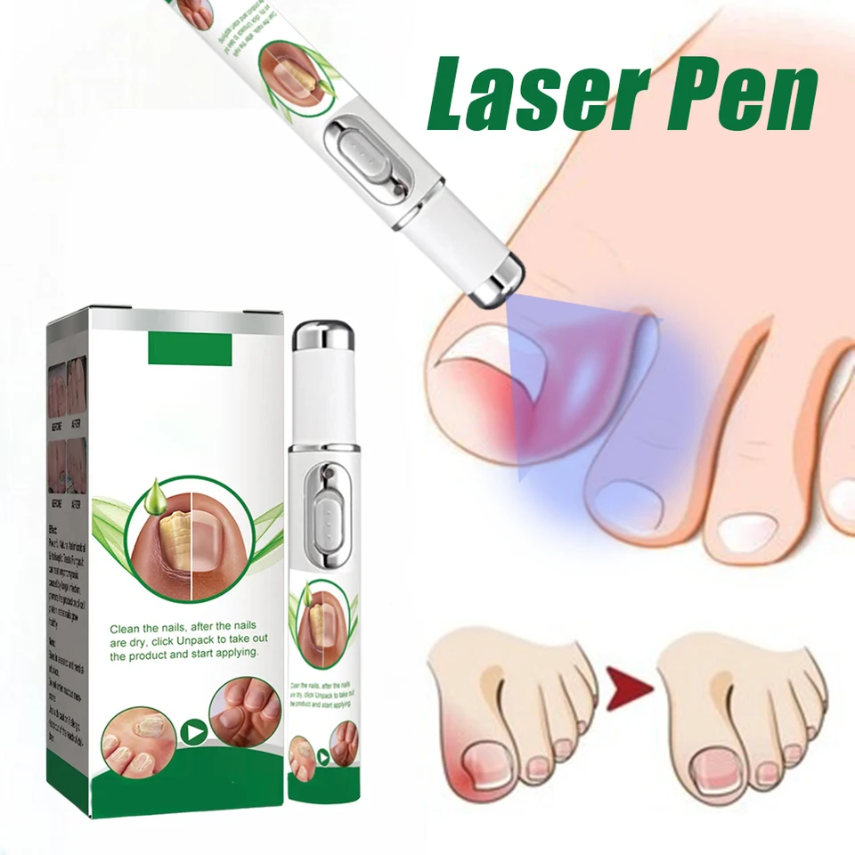 Stylo laser pour traitement des mycoses des ongles et pieds_voghion.com