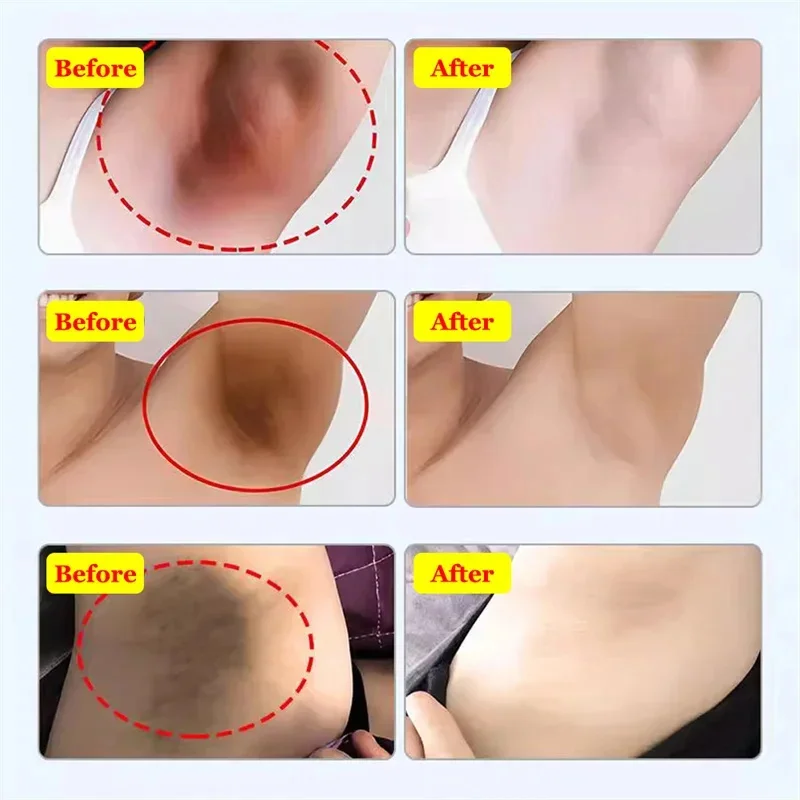 Whitening Cream Private Parts Underarm Bleaching Serum Whiten Butt Knee Brighten Inner Thigh Intimate Parts Dark Remove Melanin 4