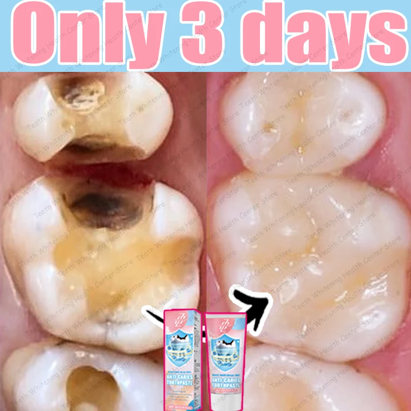 Curated visual reference: Picture Idea: What Are Tooth Decay Products And How Can They Help